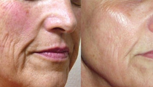 عمر بڑھنے والی جلد کے لئے سب سے موثر لیزر کیا ہے؟