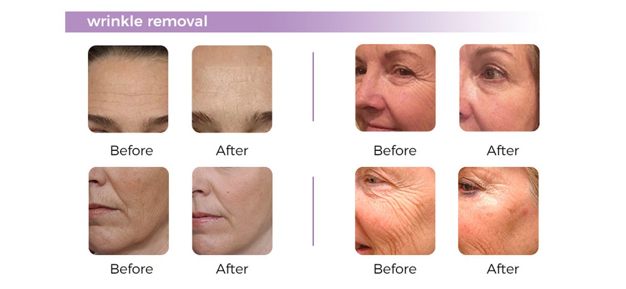 new 12d hifu Face And Body Lifting Machine new 12d hifu Face And Body Lifting Machine